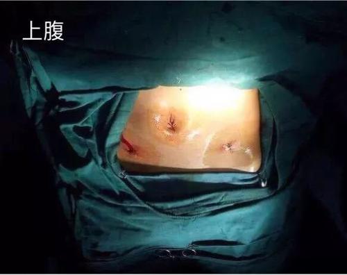宮、腹腔鏡聯(lián)合治療不孕優(yōu)勢(shì)